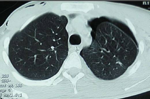 Peut On Mourir D Un Pneumothorax Pneumothorax spontané de l’adulte - Urgences-Online