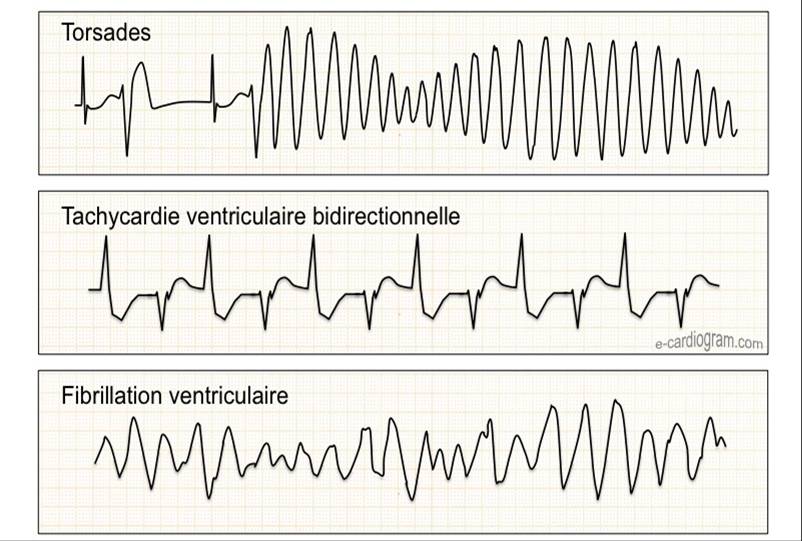 Fibrillation ventriculaire symptomes